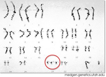 down syndrome chromosomes