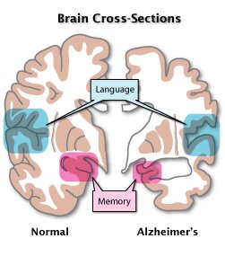 Alzheimers Brain