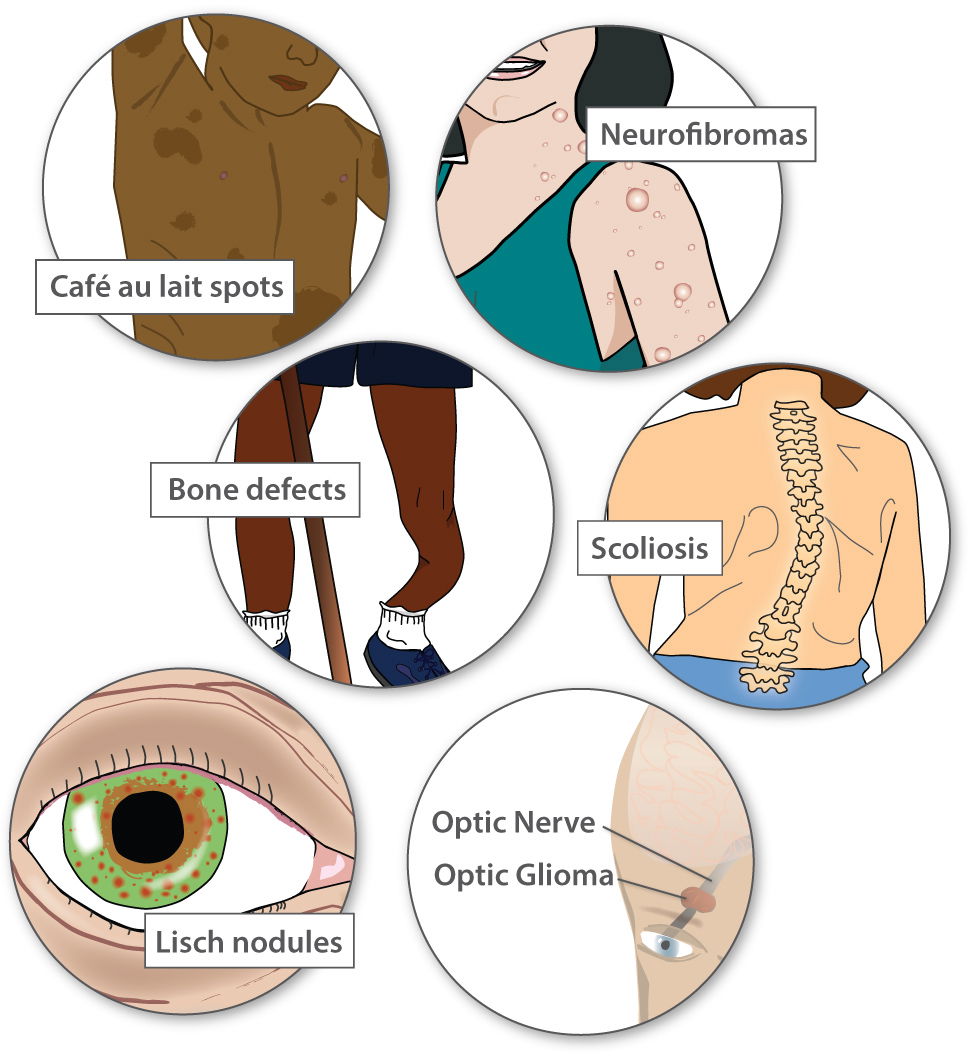 Examples Of Single Gene Disorders