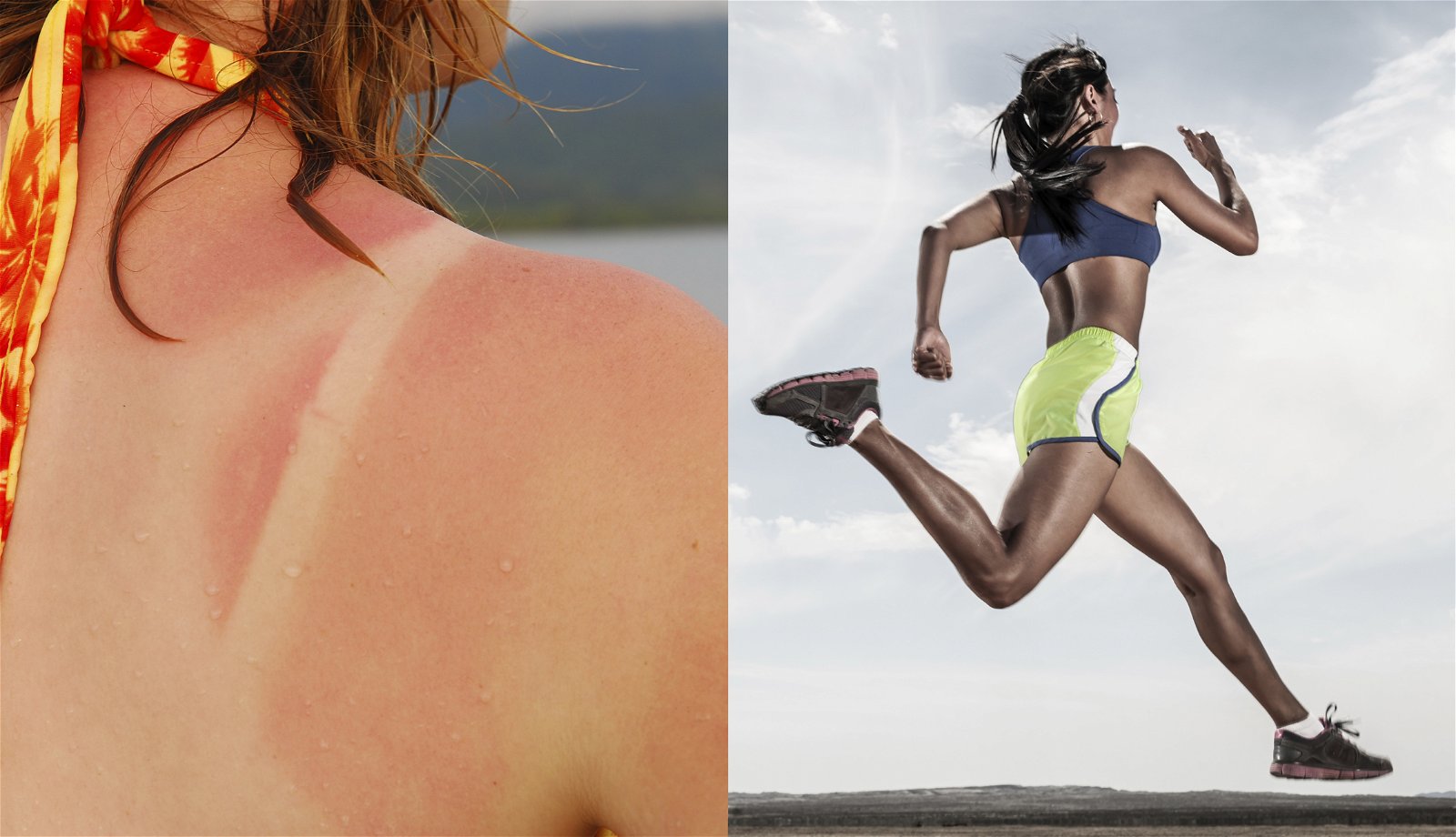 sunburn/exercise