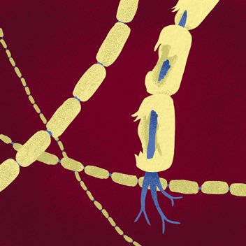 neuron with damage to myelin sheath